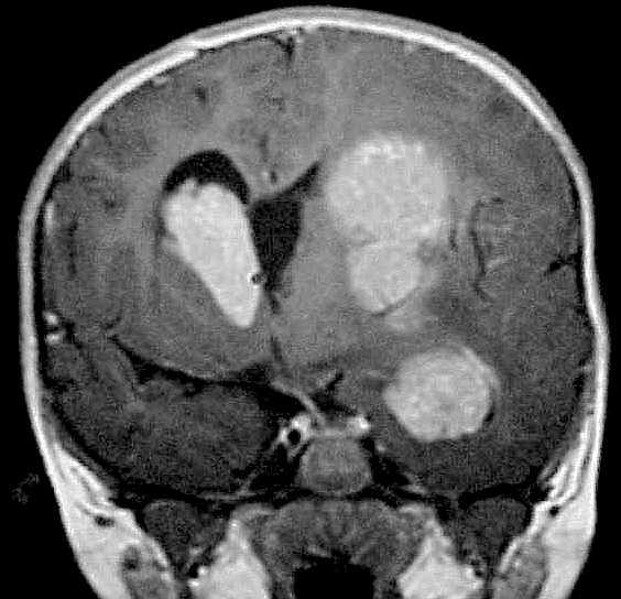 Choroid Plexus Carcinoma